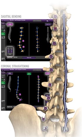 Spinal column with rod supports and software image in background