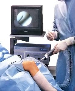 Diagnostic arthroscope being used with local anesthesia during an office procedure